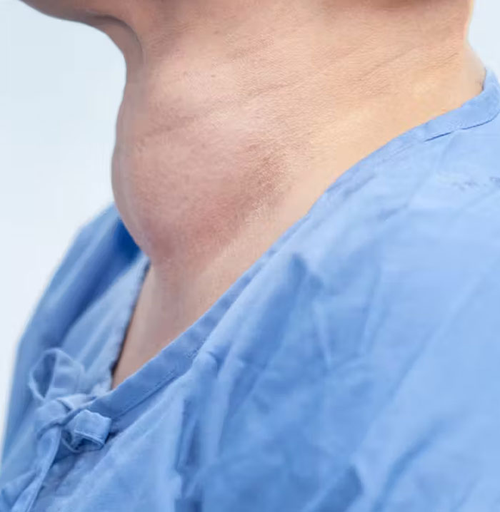 HOW IS HASHIMOTO S DISEASE TREATED visual data 7